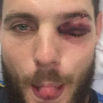 Mitchell McClenaghan to have eye surgery after being hit by ball