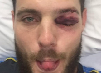 Mitchell McClenaghan to have eye surgery after being hit by ball