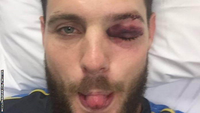 Mitchell McClenaghan to have eye surgery after being hit by ball